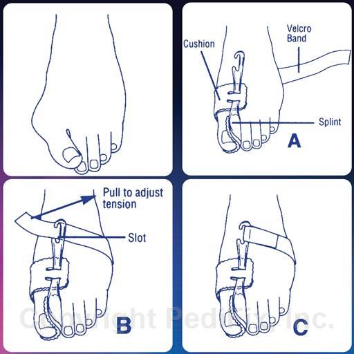 PediFix® Nighttime Bunion Regulator™